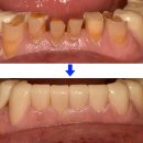 서울수치과의원 | 아래 앞니가 점점 벌어지고 닳는 이유? 앞니벌어짐·치아닳음 치료 사례