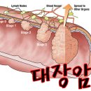 대장암 증상 "변비 해소법" 이미지