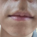 젠틀맥스 프로플러스 수염 레이저 제모 1회차 후기