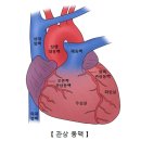 허혈성심장질환 이미지