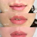 아이브 | 일산 아이브 입술라인교정 2차 후기