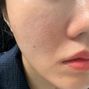 다른생각 | 강남피부과 앙코르레이저, 여드름흉터치료 2회차 경과&솔직후기! 전후비교샷