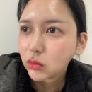 유앤지의원, 쿨페이즈 600샷 후기