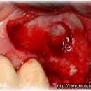 레이저를 이용한 Window opening & Bone graft 이미지