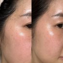 부산 편평사마귀제거 후기 | 얼굴,목, 앞가슴 부위 120개 제거하고 온 내돈내산 리뷰