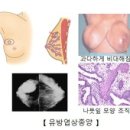 유방의 엽상종양 (Phyllodes tumor of the breast) 이미지