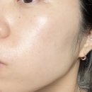 룰루랄라 마산점 | 창원 마산 피부과 볼뉴머리프팅 후기 창원리프팅 상남동리프팅