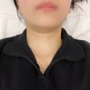 신논현역피부과 튠페이스 얼굴지방분해주사 튠팡페이스 후기(통증,다운타임)
