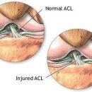 십자인대파열 원인과 치료 이미지