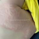 대구 어린이 유아 한의원, 시지 태양인이제마한의원 한약, 6살 땀많은 아이 체질개선
