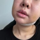 6,7 | 안면윤곽 3종+앞턱전진+귀족수술 내돈내산 후기 [6-7일차 ]