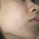 엠코드하이에듀 | 결혼식 2주 전 물광주사 릴리이드M 5cc 후기 | 여신티켓 추천인 코드 BN0DFFF9