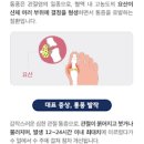 통풍의원인 증세 요산수치 낮추는 구체적 방안 파악 이미지