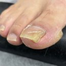 아카데미 빌리지 | 범계 발톱무좀 엠빌리지 네일 꼼꼼하고 체계적인 관리 후기