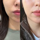 박물관역(2번출구 옆) | 옆볼필러 붓기 효과 후기 아현피부과 추천 (볼패임, 멍, 통증, 부작용)