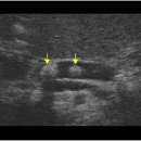 Pancreas calcifications 이미지