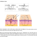 응급처치중 suture 봉합기술 이미지