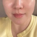 인천 구월동 피부과 온다리프팅 후기