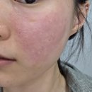 광명한증막 | 강남역 피부과 레티젠 시술 바디 온다 후기