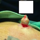 창녕약국 | [창녕합천피지낭종] 피지낭종 없애는 가장 빠른 방법은? 후기 비교 분석