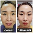 인셀덤 윈썸점 피부개선 패키지 케어 후기 [50대 조ㅇ숙님]