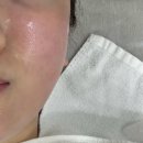 진마디의원 | 부산 서면 피부과/ 통증없는 리프팅 온다5만줄 솔직 후기(당일~6일차) 닥터에버스의원 부산서면점