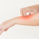 알레르기 이미지