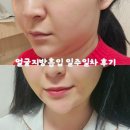 이중턱지방흡입 후기 일주일만에 투턱 없애는 법 (붓기, 통증, 회복기간, 주의사항)
