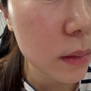 양이멍이 | 인천 송도피부과 쥬베룩 스킨부스터 효과 후기