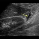 Complicated appendicitis 이미지