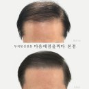 촘촘 스칼프 이미지