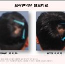 원형한의원 | 원형탈모 치료 후기, 탈모치료법, 오금탈모병원에서 알려드립니다