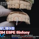 캘리포니아치과의원 | 앞니 벌어짐 레진치료, 보철 (신포니, 라미네이트, 크라운) 차이는 무엇일까?