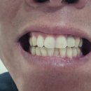 덴탈톡 | 분말치약 덴타르트치석흡착팩 효과로 매끈해지는 덴탈팩 후기