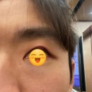 구리남양주 | 속다래끼 째기, 3주 경과, 구리 남양주 병원 후기