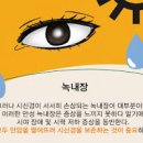 눈병 종류별 증상, 눈 충혈 원인과 치료 이미지