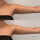 미당 에스테틱 | 천안 바디슬리밍 에스테틱 / 팔뚝살만 싹뚝 컷팅성공(내돈내산 찐후기)