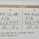 밝은안과21병원 | 라섹 후기 (광천동 밝은안과21병원)