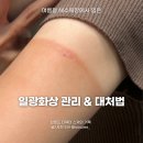 일광 | 해수욕장 일광화상 관리 후기 & 대처법, 연고, 껍질, 알로에 총정리