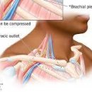 흉곽출구 증후군 (손가락 손저림, 오른쪽 왼쪽 팔저림, 가슴통증) 이미지