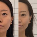 연제구-137 | 부산 예신피부관리 프랑스물광필링 더하늘에스테틱