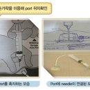 Chemoport (케모포트) 카테터 이미지