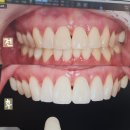 이가편한치과의원 | [대전 치아미백 후기] 연세맘편한치과에서 경험한 솔직 후기