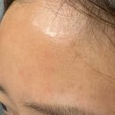 당산한의원 | 당산 여드름한의원 : 잡티없는 피부가 되기위한 여드름쟁이의 일상 / 색소침착에 효과적인 미세약초침...