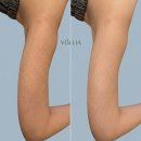 온에스테틱 아카데미 | 볼리아에스테틱내돈내산 팔모공각화증 닭살피부 해결해준 송파 트러블흉터관리