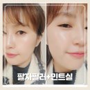 또팔자 | 대구 동성로 피부과 팔자필러와 민트실로 팔자주름 고민해결