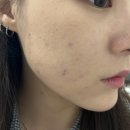 운정피부관리 추천! 여드름 피부 맞춤 CO2 카복시 받고 온 비엔비 스파 에스테틱 후기