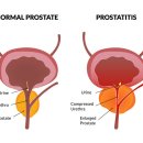 전립선염[prostatitis] 이미지