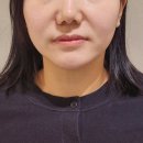 과천역 2번출구 뒤 | 방배동 피부과 티타늄리프팅 효과 및 비용 내돈내산 후기