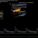 Carotid sono 이미지